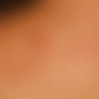 Collagenosis, reactive perforating p apules: first appeared about 8 months ago, itchy papules wit...