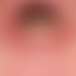 Lentigo of the mucous membrane: sharply defined, brownish hyperpigmentation of the red of the lip...