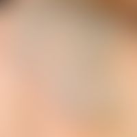 Malformation venöse&nbsp;: tief kutan gelegene segmentale venöse Malformation (alte Bezeichnung: ...