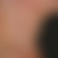 Naevus anaemicus: irregularly limited, white, smooth stain, "always have been there". after rubbi...