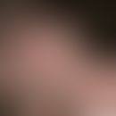 Pseudopelade:&nbsp;unregelmäßig begrenzter, haarloser Bezirk.&nbsp;Bei Vergrößerung (s. Inlet)&nb...