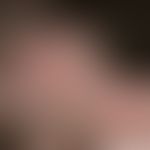 Pseudo-pelade: irregularly limited, hairless area. on enlargement (see inlet) it becomes clear th...