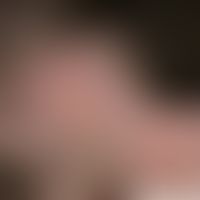 Pseudo-pelade: irregularly limited, hairless area. on enlargement (see inlet) it becomes clear th...