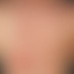 Pemphigus erythematosus (Zustand nach UV-Provokation): seit etwa&nbsp;2 Jahren rezidivierende, sy...