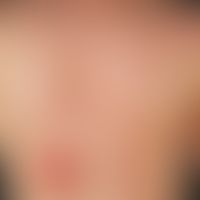 Pemphigus erythematosus (state after UV-provocation): since about 2 years recurrent, symmetrical ...