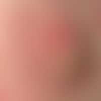 Karzinom kutanes: Fortgeschrittenes, flächig ulzeriertes &nbsp;Plattenpithelkarzinom.
