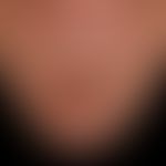 Lip carcinoma: broad, firm, painless, wart-like, eroded and ulcerated plaque with deposits on the...