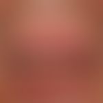 Lip carcinoma: a broad, firm, painless, wart-like, eroded and ulcerated lump on the lower lip; di...