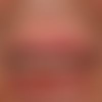 Lip carcinoma: a broad, firm, painless, wart-like, eroded and ulcerated lump on the lower lip; di...