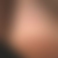 Schwielenbildung mit trockener feinlamellärer Schuppung der Ferse.
