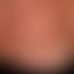 DRESS: Detailed picture. 4 weeks after taking carbemazepine, occurrence of this generalized macul...