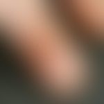 Pyoderma (overview): recurrent streptococcal pyoderma in a patient with atopic eczema; recurrence...