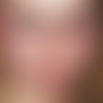 mononucleosis, infectious. swallowing difficulties for 5-6 days; fever > 39 °C. generalized, n...