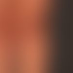 Varicose vein/thigh: Such a varicose vein is often thought to be a truncal varicose vein of V. sa...