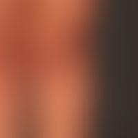 Varize/Oberschenkel: Eine derartige Varize wird häufig für eine Stammvarikose der V. saphena magn...