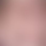 Lentigo solaris: multiple, disseminated, a few millimetres to 1.5 cm in size, oval, roundish or b...