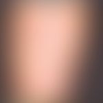 Kratzeffekte bei chronisch intermittierendem Pruritus.
