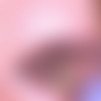 Mucous granuloma: Condition after traumatic injury of the cheek mucosa, now after several months ...