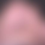 Epidermolysis bullosa simplex, Weber-Cockayne. Akute, nach 2-stündigem Fußmarsch aufgetretene, sc...