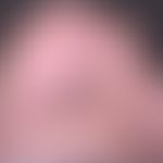 Epidermolysis bullosa simplex lokalisierte (Weber-Cockayne). 2 Tage alte Blase hier eingekreist.
