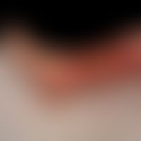 Venous leg ulcer in the context of a post-thrombotic syndrome and arthrogenic congestion syndrome...