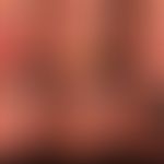 Differential diagnosis of melanonychia: In figure V the arrow points to the pigmentation of the n...