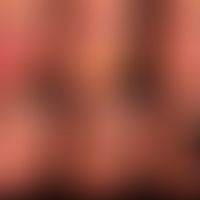 Differential diagnosis of melanonychia: In figure V the arrow points to the pigmentation of the n...