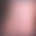 Tinea pedis Mokassin-Typ. Trockene zirzinäre Abschuppung der Fußsohlen. Keine Bläschenbildung. Fu...