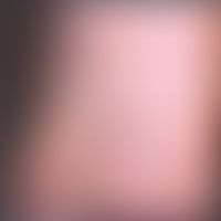 Tinea pedis Mokassin-Typ. Trockene zirzinäre Abschuppung der Fußsohlen. Keine Bläschenbildung. Fu...