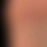 Lichen planus exanthematicus: Detailed section with circumscribed infestation of the sole of the ...