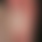 Lichen planus exanthematicus: Detail of the foot sole with extensive flat infestation of the sole...
