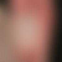 Lichen planus exanthematicus: Detail of the foot sole with extensive flat infestation of the sole...