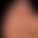 Schwielen: Schwielenbildung durch Tragen hochhackiger Schuhe (s. erklärende nachfolgende Abbildung)
