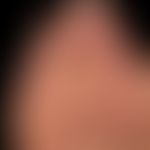 Schwielen: eingekreiste Druckschwielen. Großer Halbkreis mit Stern = Hallux valgus.&nbsp;
