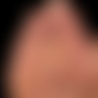 Schwielen: eingekreiste Druckschwielen. Großer Halbkreis mit Stern = Hallux valgus.&nbsp;

