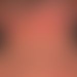 Dermatosis acute febrile neutrophils: acute, exanthematic clinical picture with affection of face...
