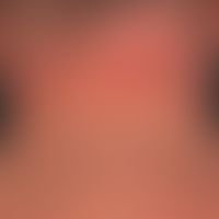 Dermatosis acute febrile neutrophils: acute, exanthematic clinical picture with affection of face...