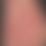 Dermatosis acute febrile neutrophils: acute, exanthematic clinical picture with affection of face...