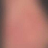 Dermatosis acute febrile neutrophils: acute, exanthematic clinical picture with affection of face...