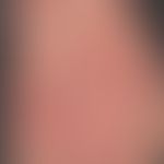 Plaques und Papeln rot: Dermatose akute febrile &nbsp;neutrophile: akutes, exanthematisches Krank...