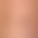 papules, brown marked by arrows: in the case of a papule, a "raised area" is always palpated. 2 b...