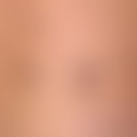 papules, brown marked by arrows: in the case of a papule, a "raised area" is always palpated. 2 b...