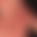 Dermatosis acute febrile neutrophils: acute, exanthematic clinical picture, here further advanced...