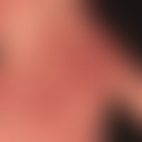 Dermatosis acute febrile neutrophils: acute, exanthematic clinical picture, here further advanced...