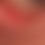 trichiasis in chronic eyelid eczema. noticeable doubling (partly also tripling) of the irregularl...