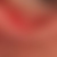 trichiasis in chronic eyelid eczema. noticeable doubling (partly also tripling) of the irregularl...