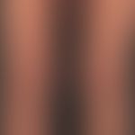Graft-versus-Host-Disease, chronic. about 1.5 years after a stem cell transplantation, large-area...