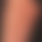 Graft-versus-Host-Disease, chronic. 1.5 years after a stem cell transplantation, extensive harden...