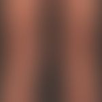 Graft-versus-Host-Disease, chronic. about 1.5 years after a stem cell transplantation, extensive ...