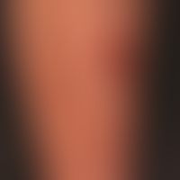 Nummular Dermatitis: For 6months persistent, itchy, eroded, excoriated, partly encrusted, coin-sh...